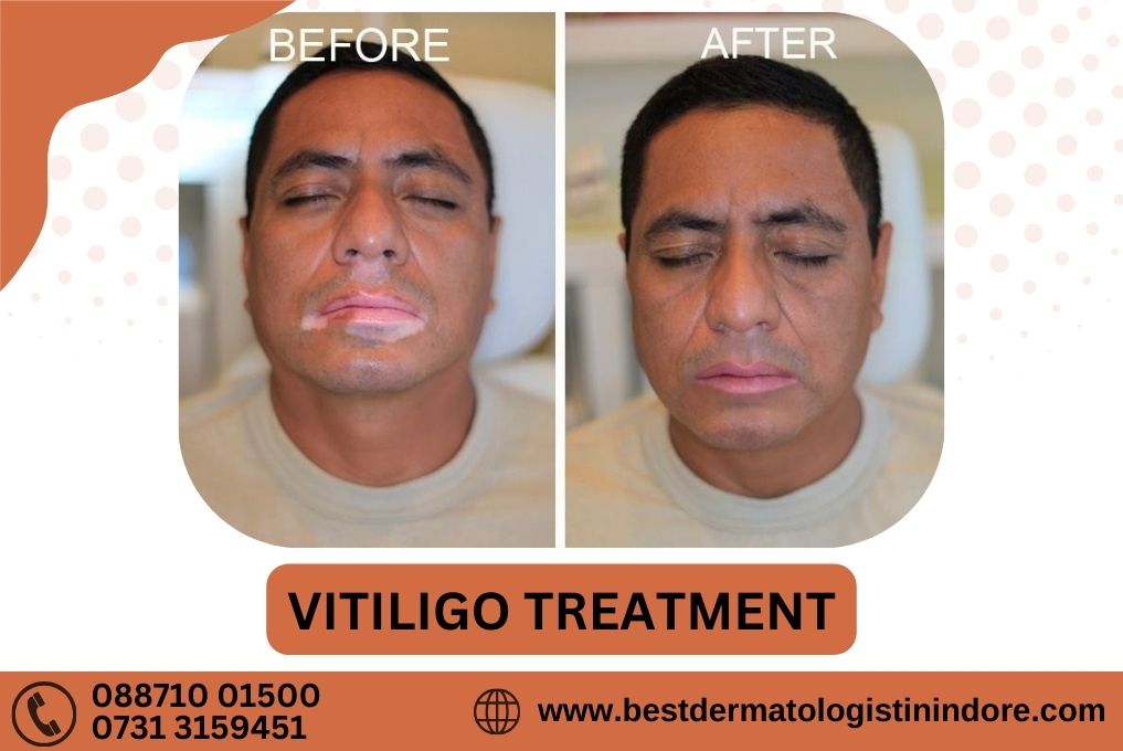 Vitiligo Specialist In Indore