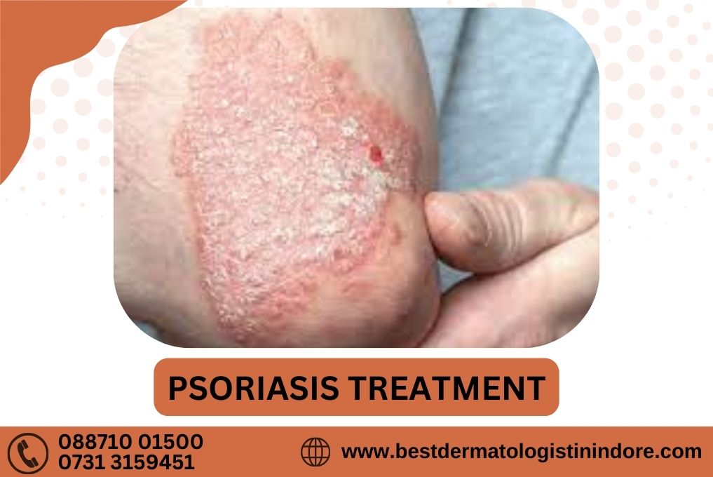 Psoriasis Treatment In Indore