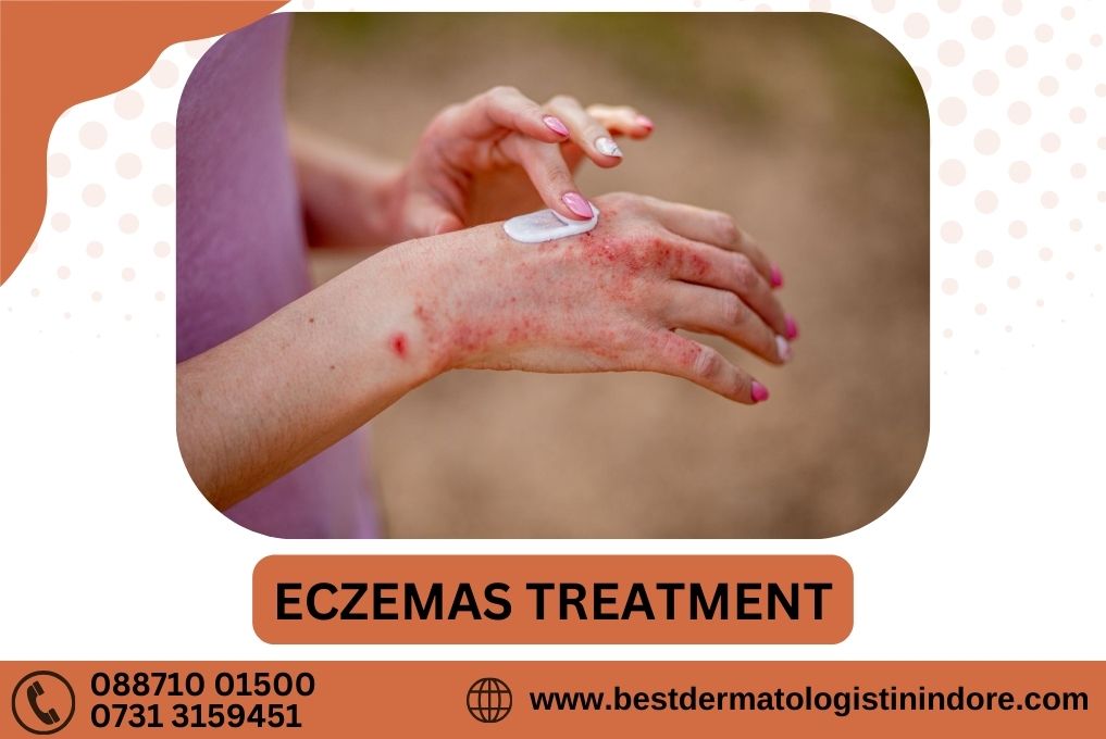 Eczemas Treatment in Indore