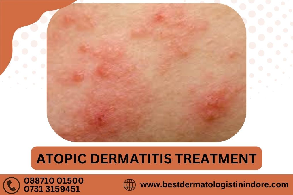 Atopic Dermatitis Treatment In Indore