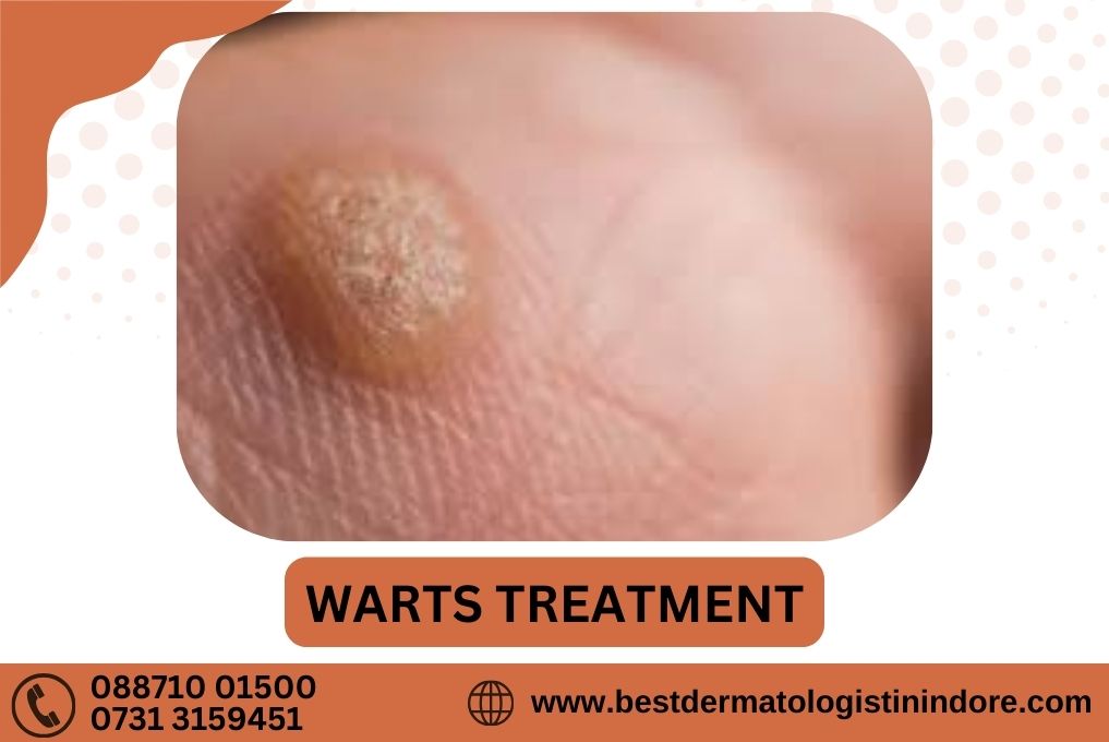 Warts Treatment in Indore