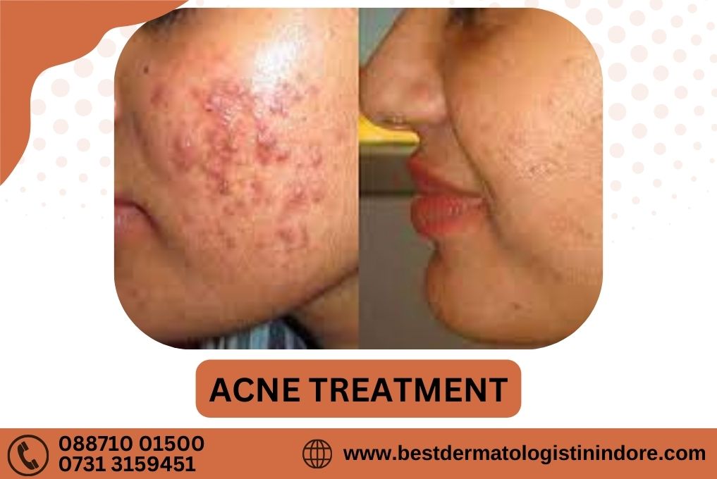 Acne Treatment In Indore