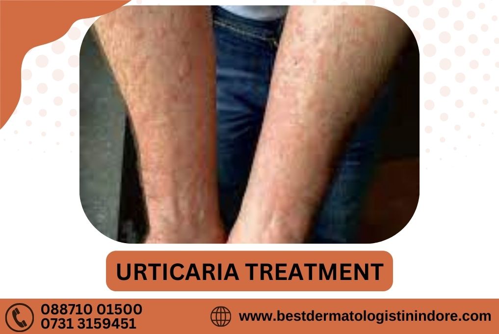 Urticaria Treatment in Indore