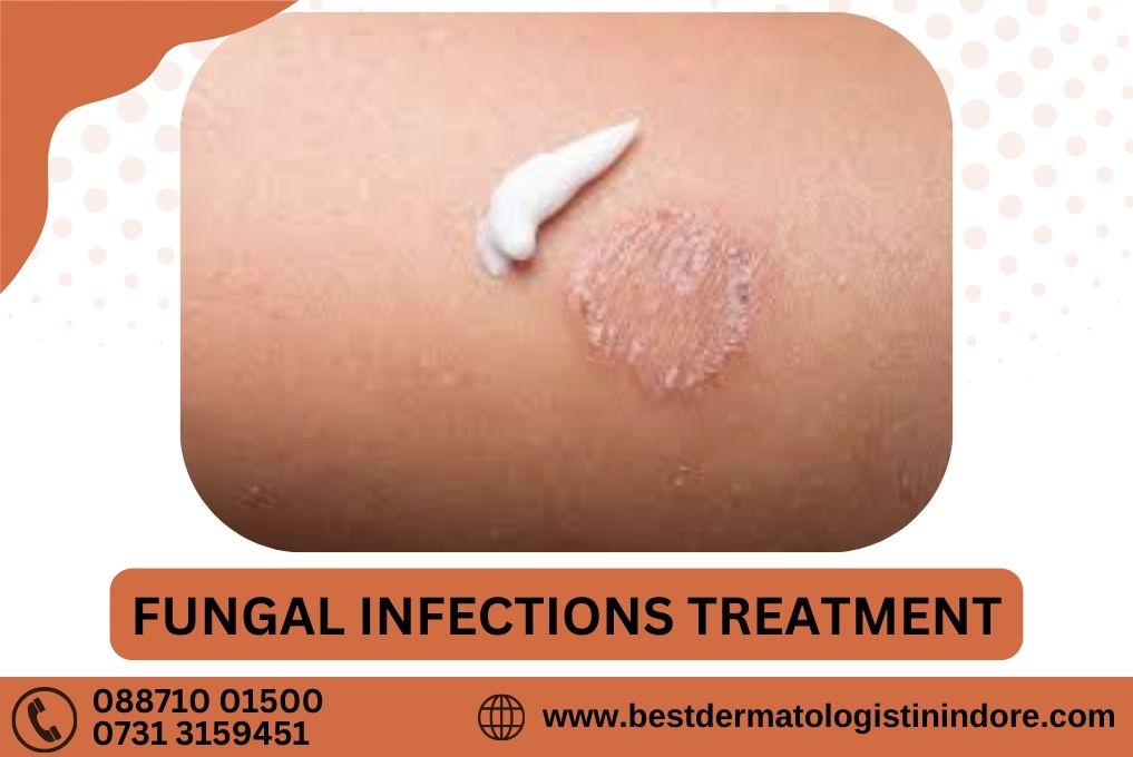 Fungal infection Treatment In Indore