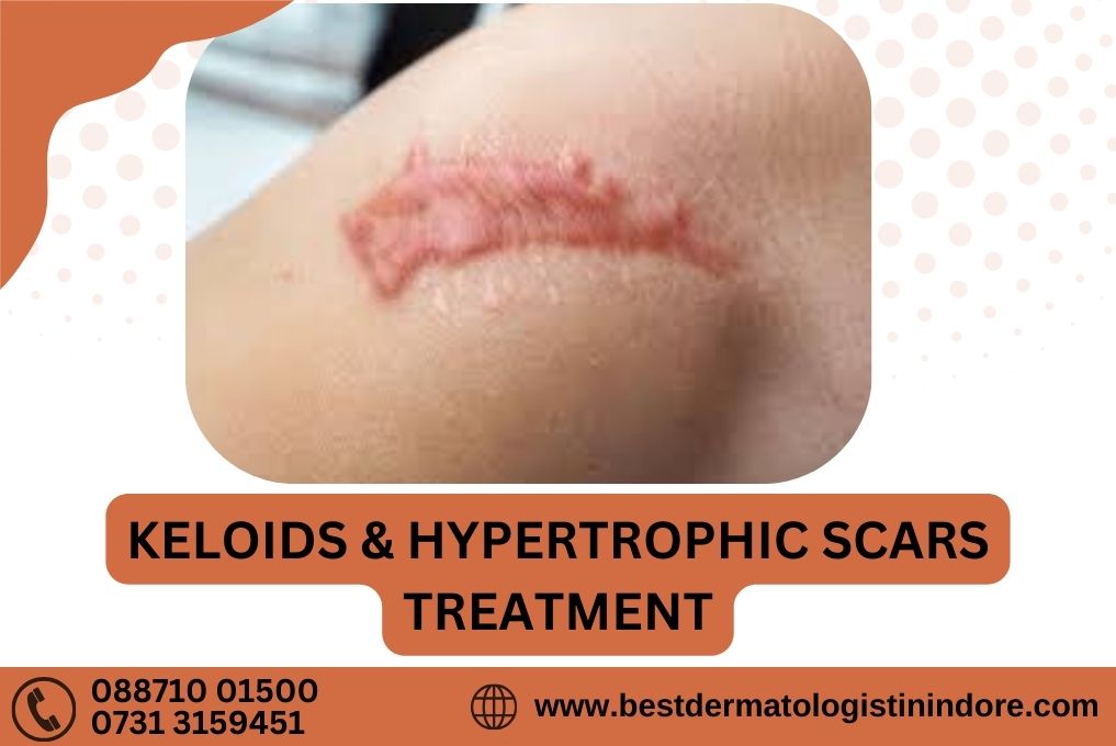 Keloids and hypertrophic scars Treatment in Indore