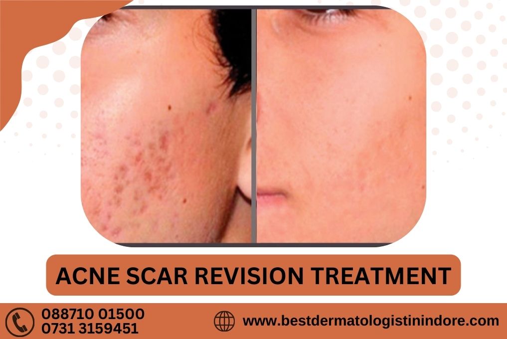 Acne Scar Revision Treatment In Indore