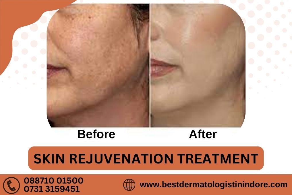 Skin Rejuvenation Treatment Specialist In Indore