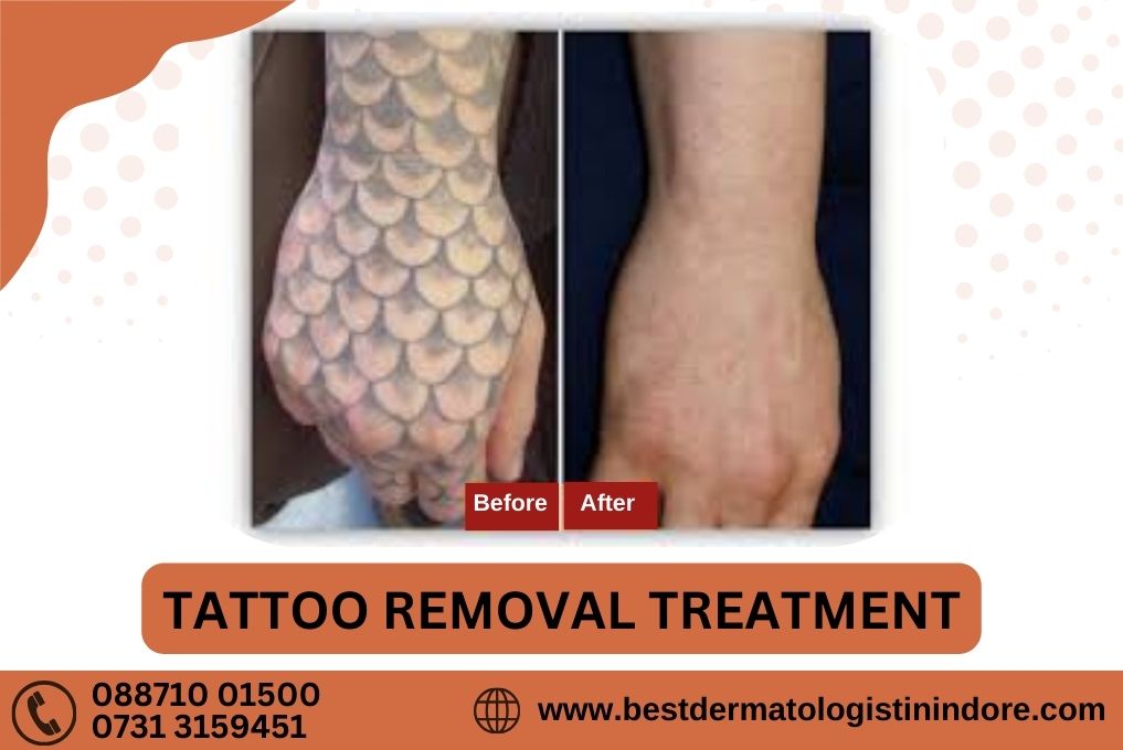 Face Tattoo Removal Services by Tatt2Away®