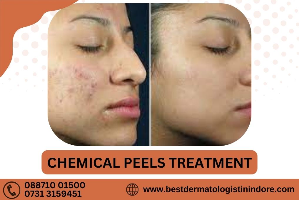 Chemical Peel Treatment Specialist in Indore