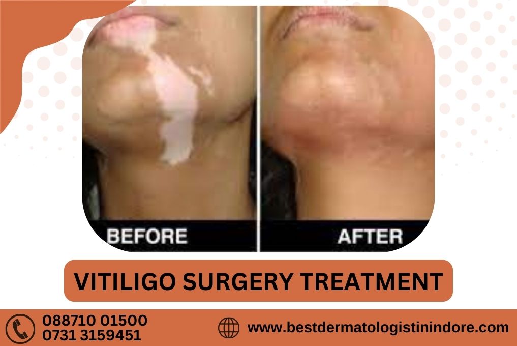 Vitiligo Surgery Treatment In Indore