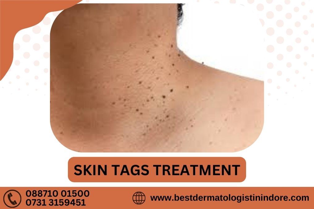 Best Clinic For Skin Tags Treatment in Indore