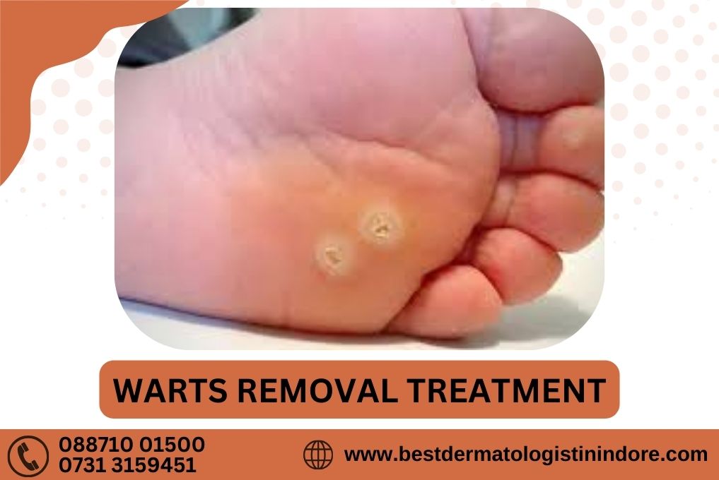 Best Warts Removal Specialist in Indore