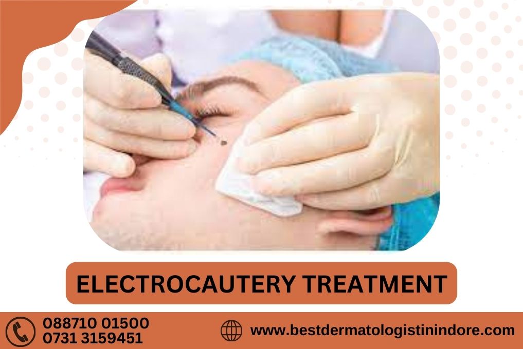 Electrocautery Treatment Specialist in Indore