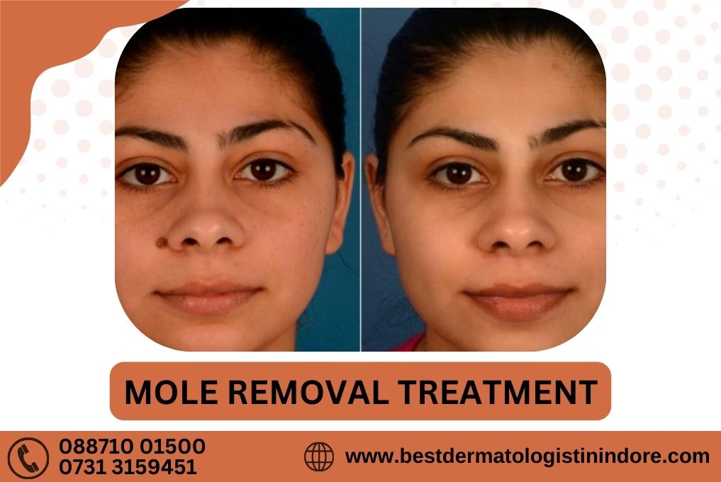 Best Dermatologist for mole removal treatment in Indore