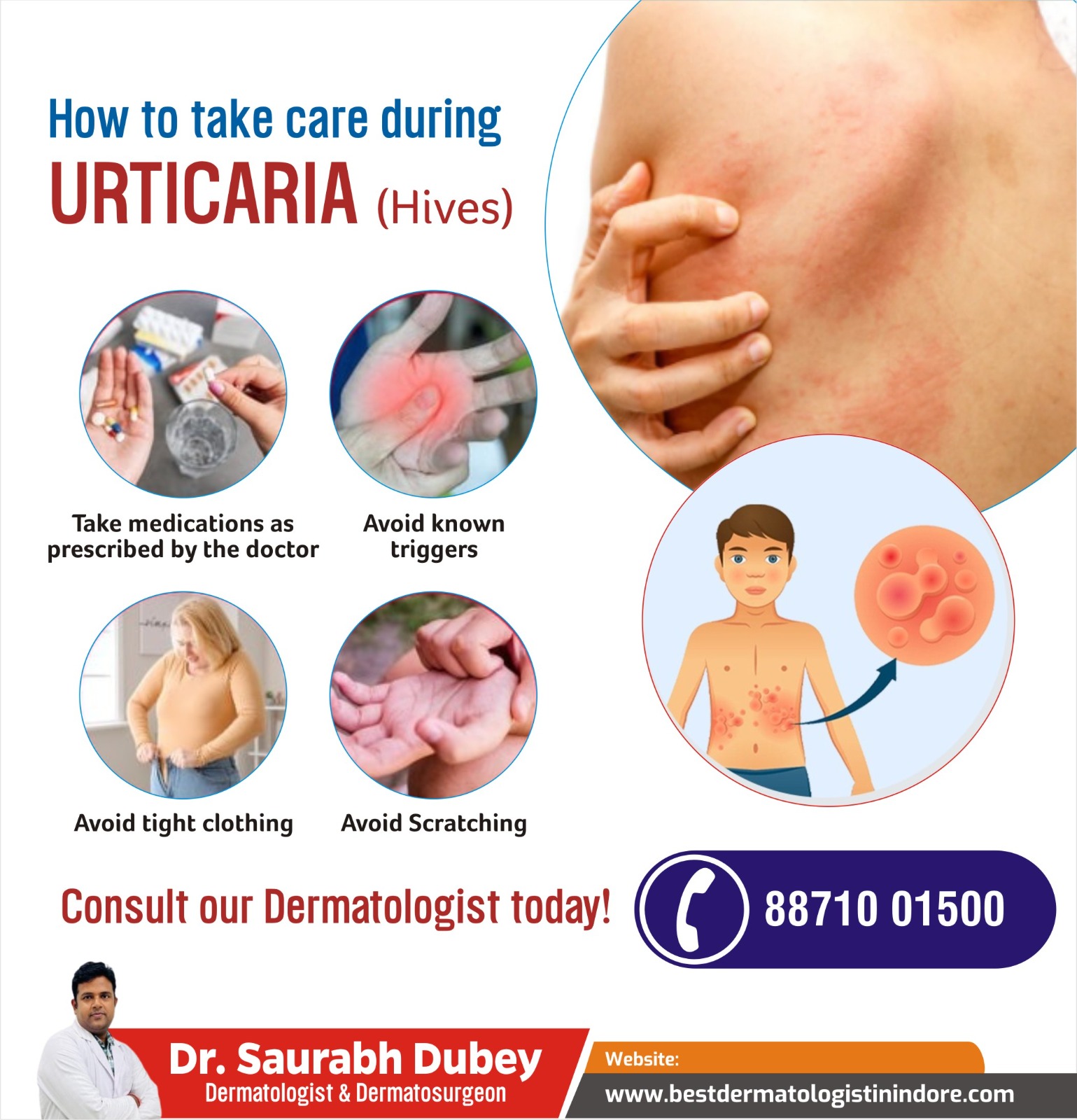 Top Skin Specialist for Urticarial Treatment in Indore