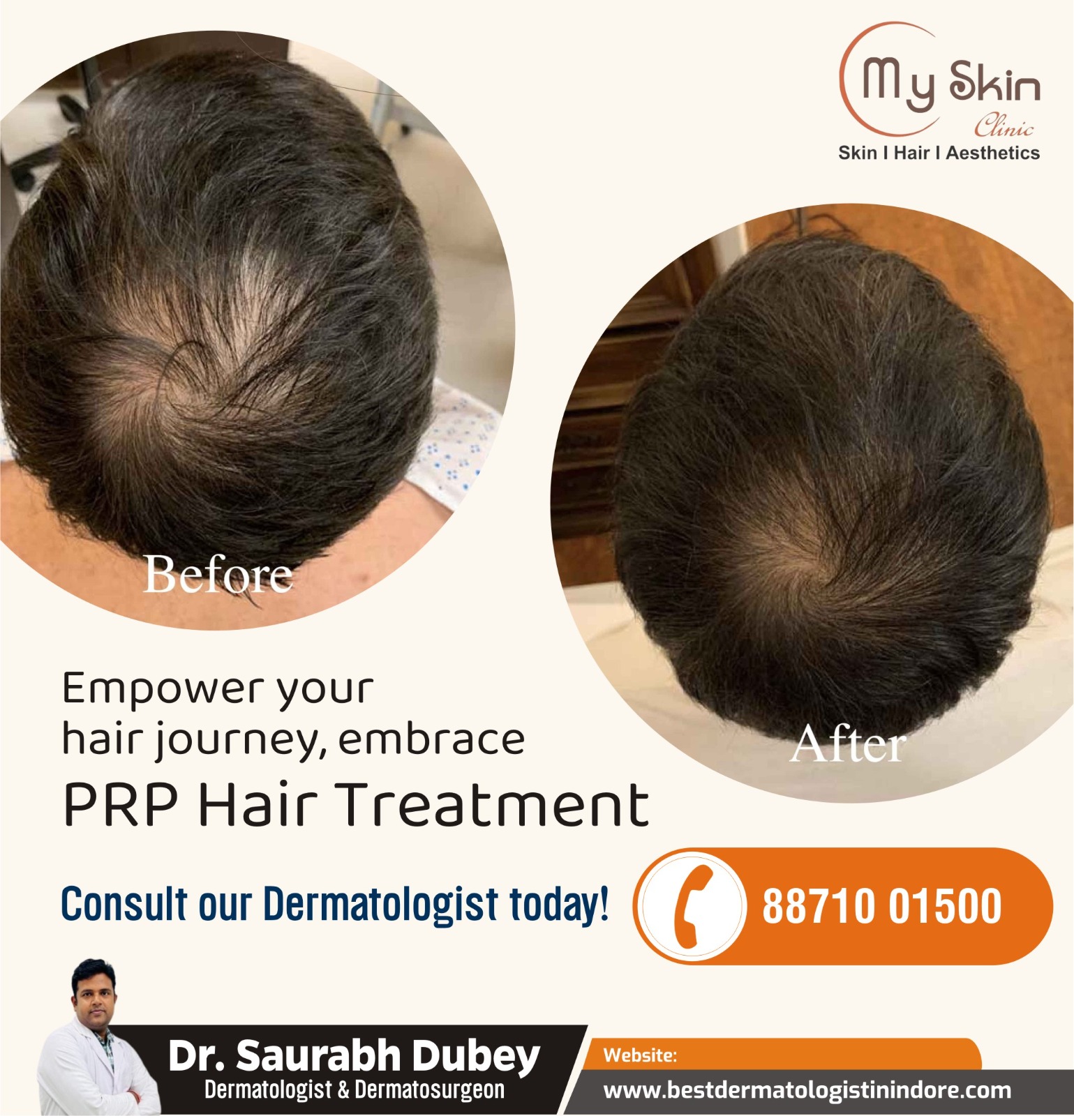 Best Hair PRP Specialist in Indore