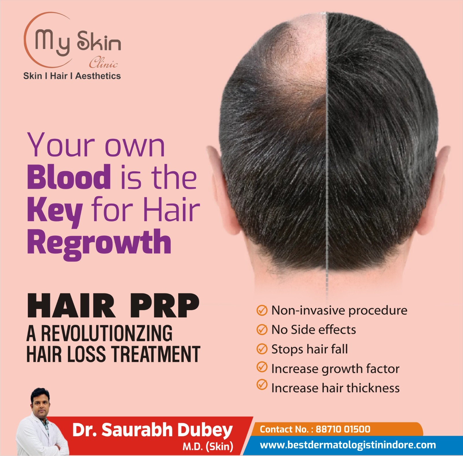 Best Hair Specialist for PRP Treatment in Indore