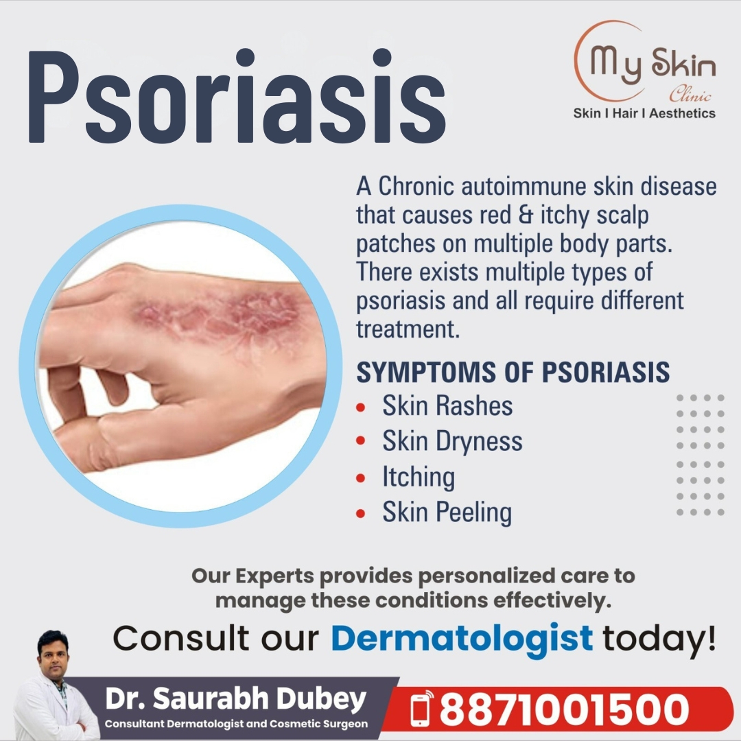 Best Skin Specialist for Psoriasis Treatment in Indore