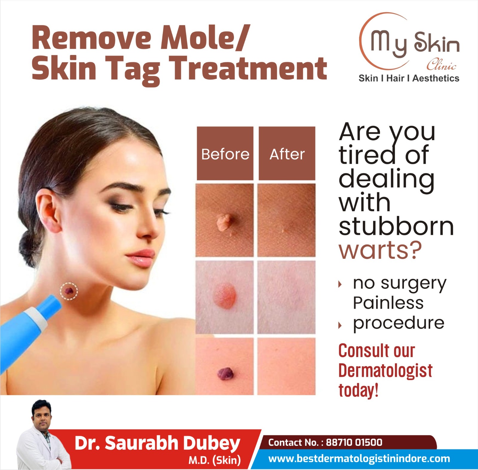 Top Dermatologist For Mole Removal In Indore