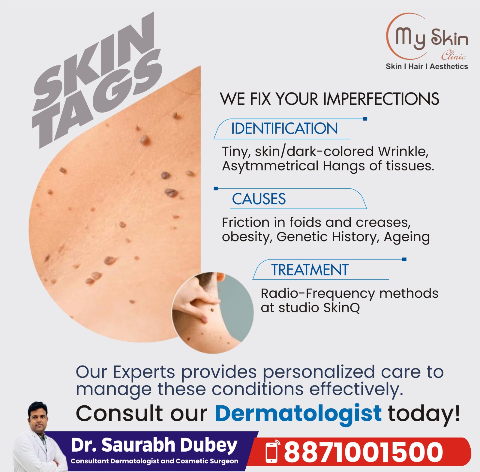 Best Skin Doctor for Skin Tags Removal in Indore