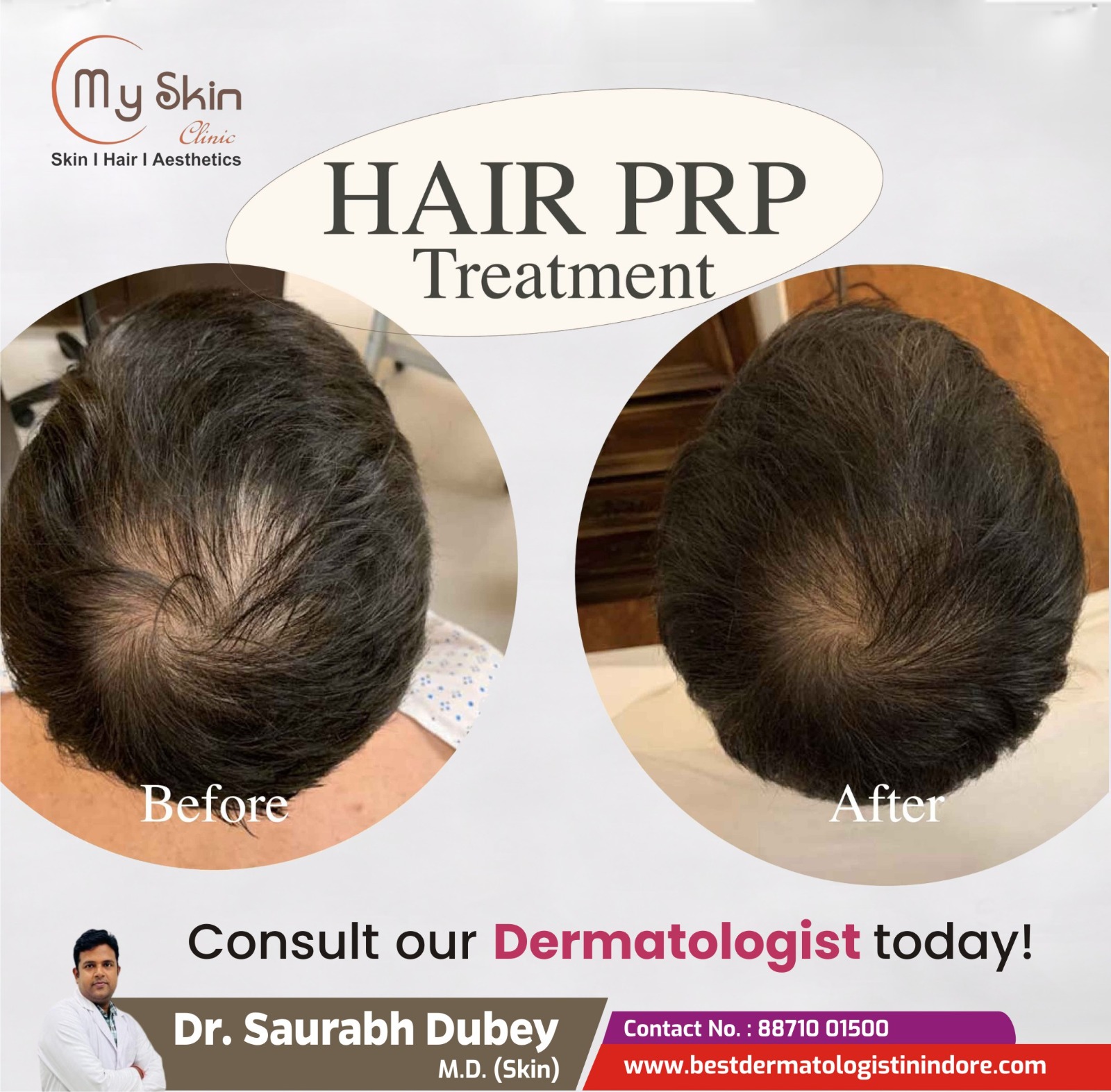 Best Hair Specialist for PRP Treatment in Indore