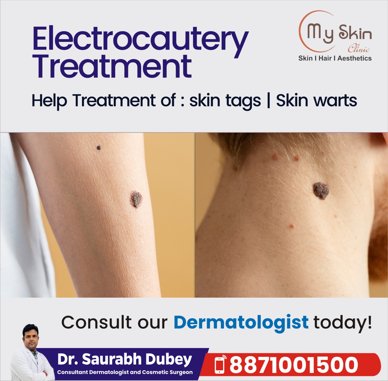 Best Electrocautery Specialist in Indore