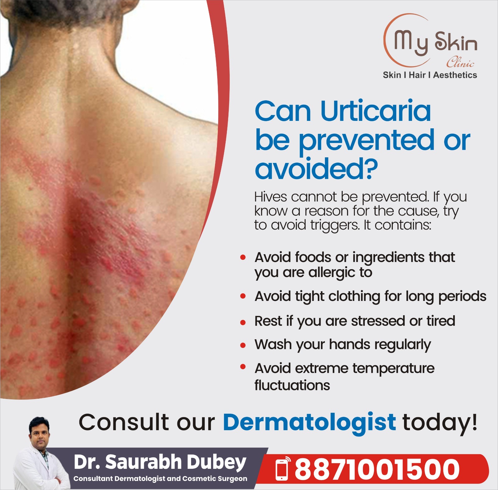 Best Skin Specialist for Urticaria Treatment in Indore