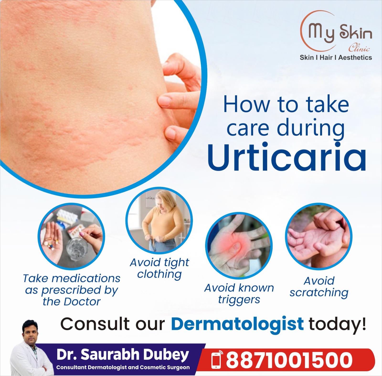 Best Urticaria Specialist in Indore