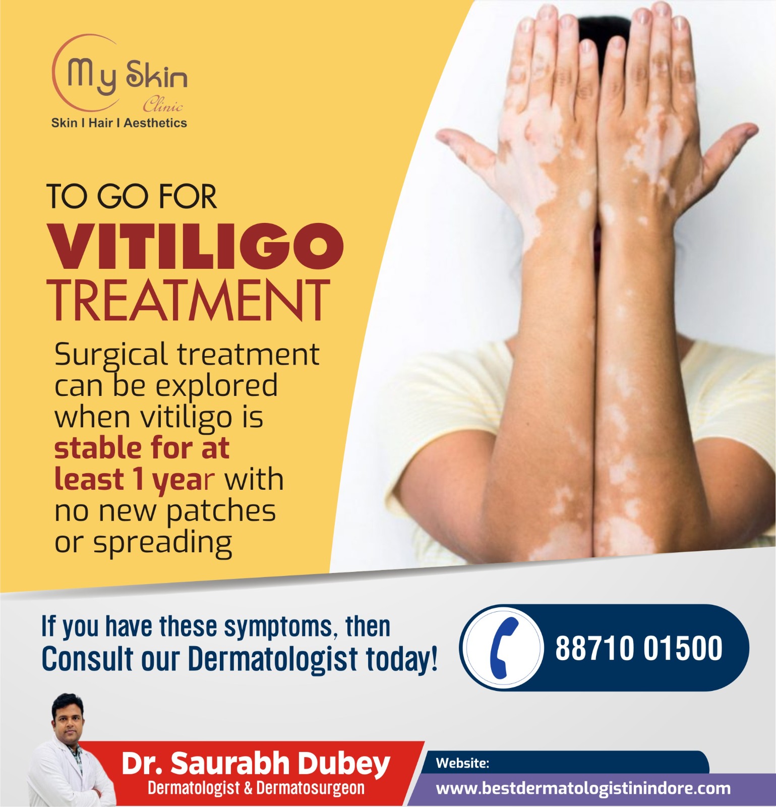 Best Skin Doctor for Vitiligo Treatment in Indore