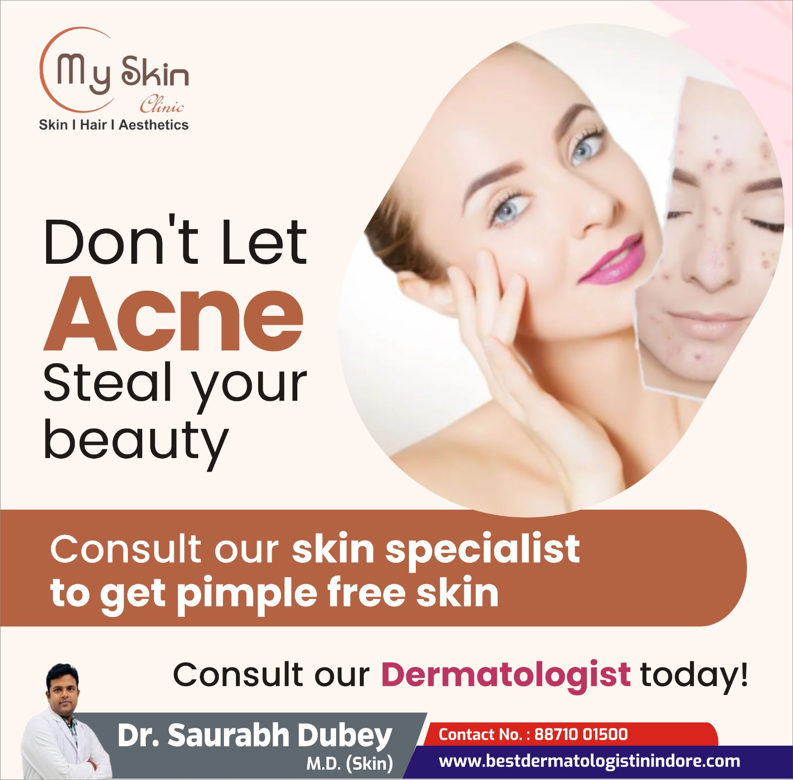 Best Acne Specialist in Indore