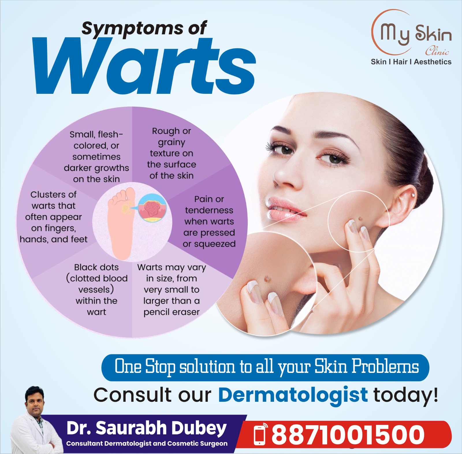 Best Skin Doctor for Warts Treatment in Indore 