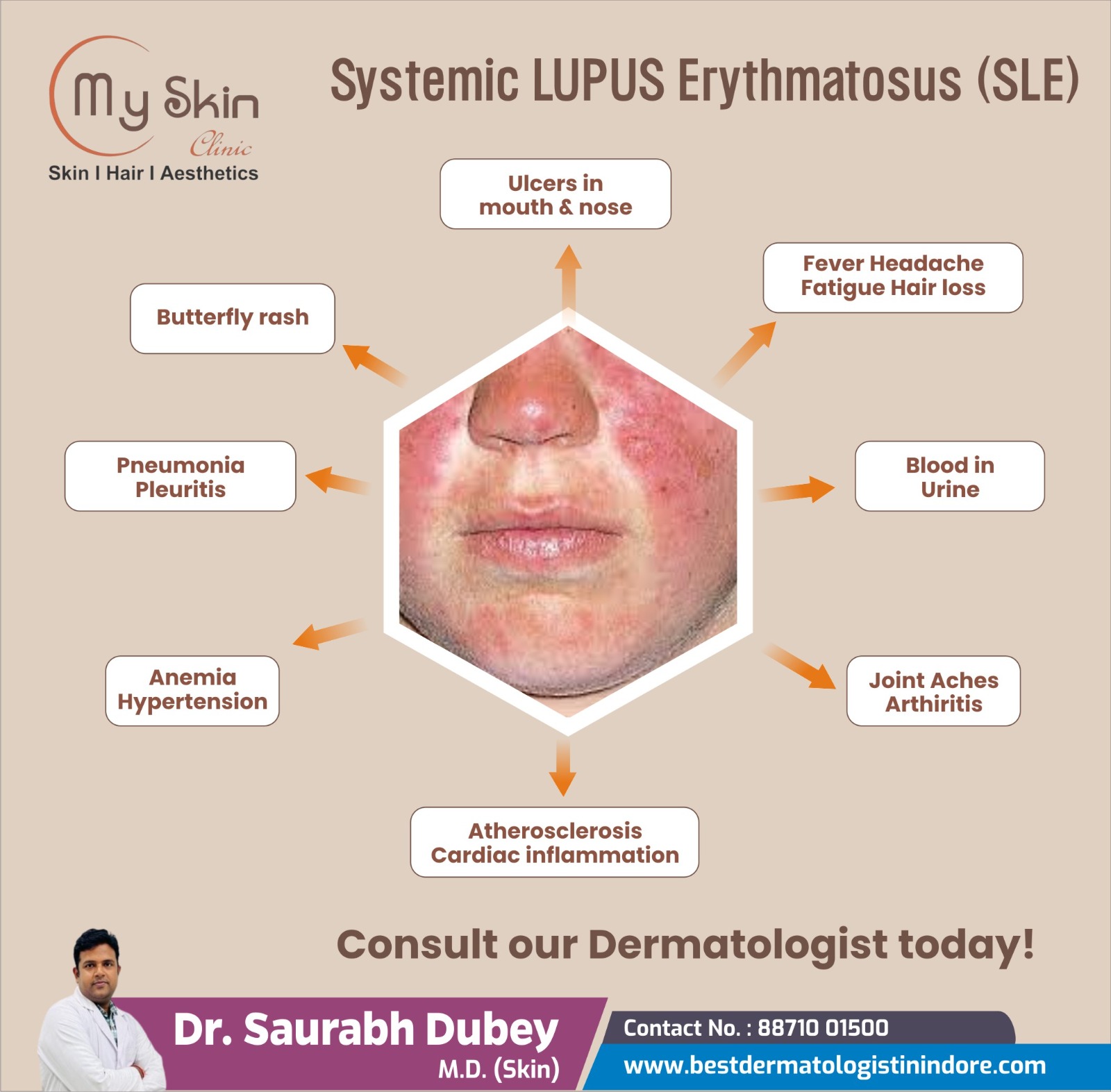 Best Skin Specialist for Systemic Lupus Erythematosus Treatment in Indore