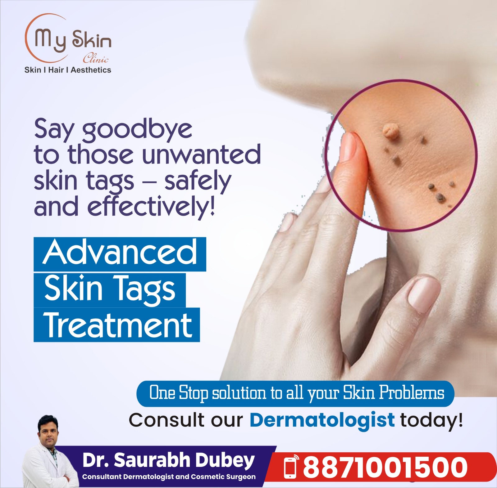Best Skin Doctor for Skin Tags Treatment in Indore 