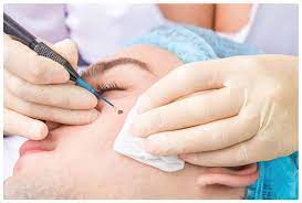 Best Skin Specialist for Warts Removal In Indore