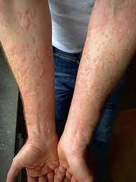 Best Doctor for Urticaria Treatment in Dhar