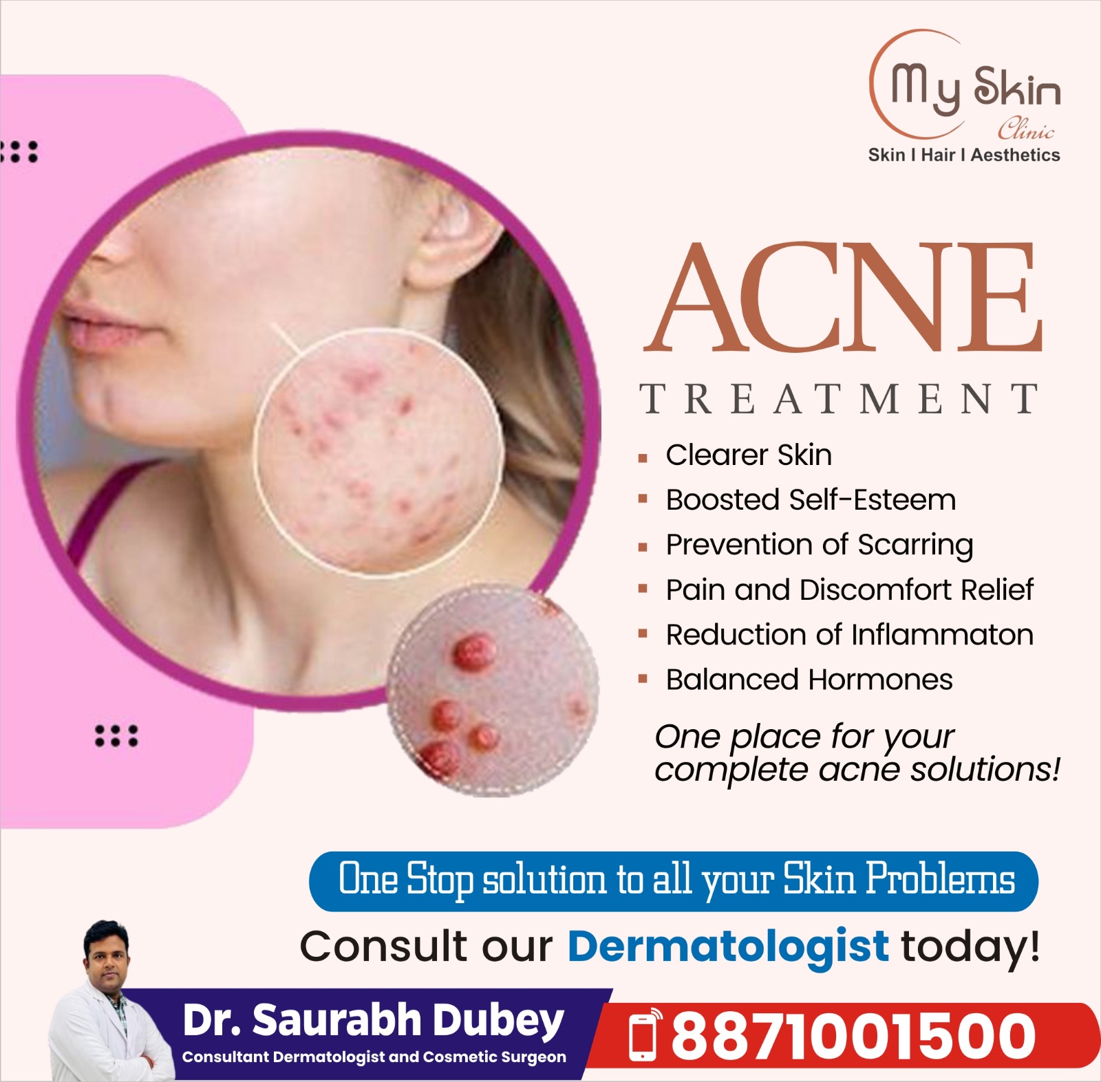 Best Skin Doctor for Acne Treatment in Indore 