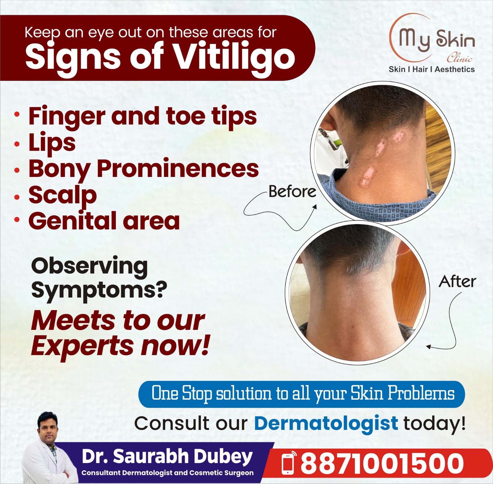 Best Skin Doctor for Vitiligo Treatment in Indore