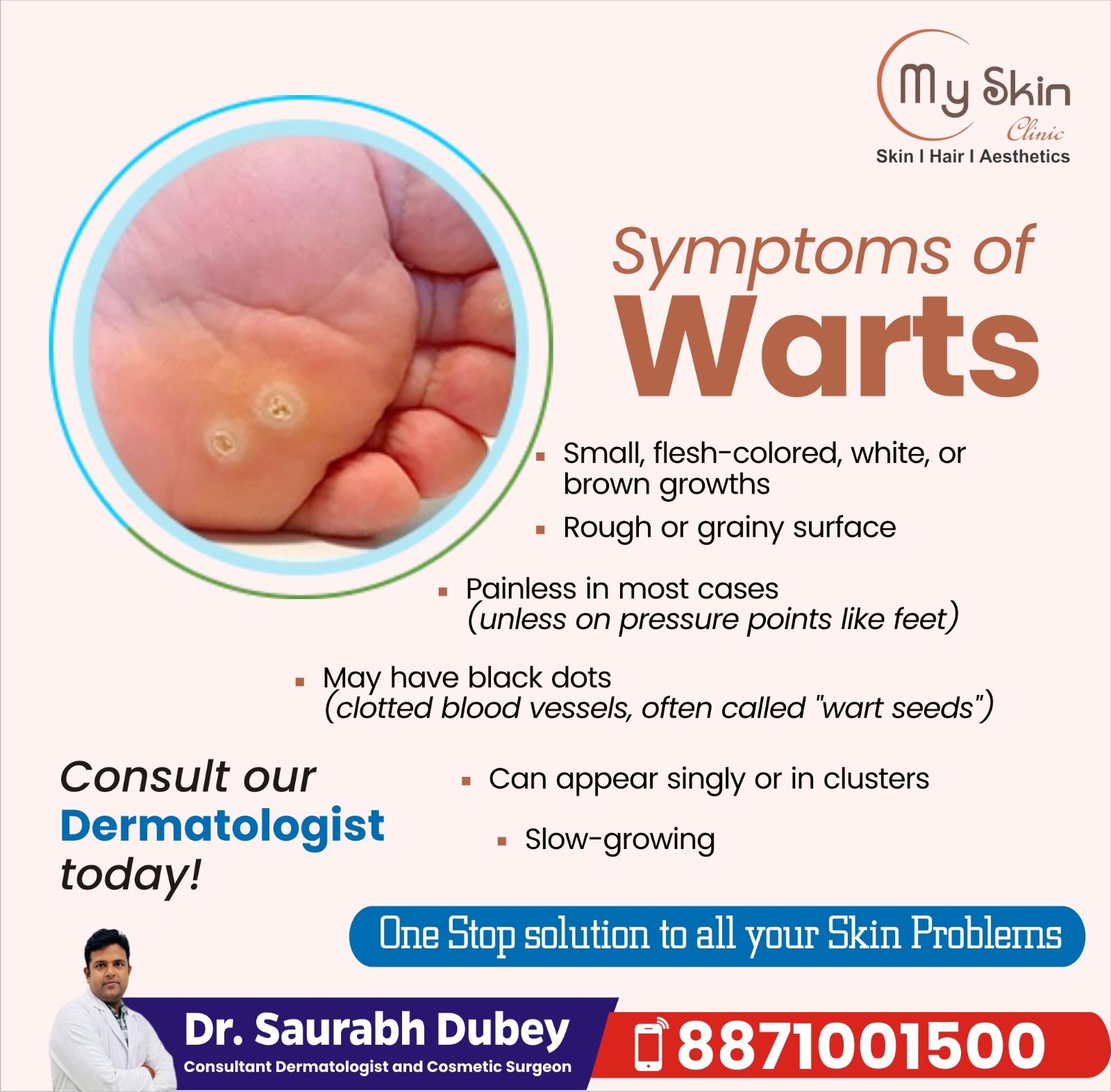 Best Skin Doctor For Warts Removal in Indore