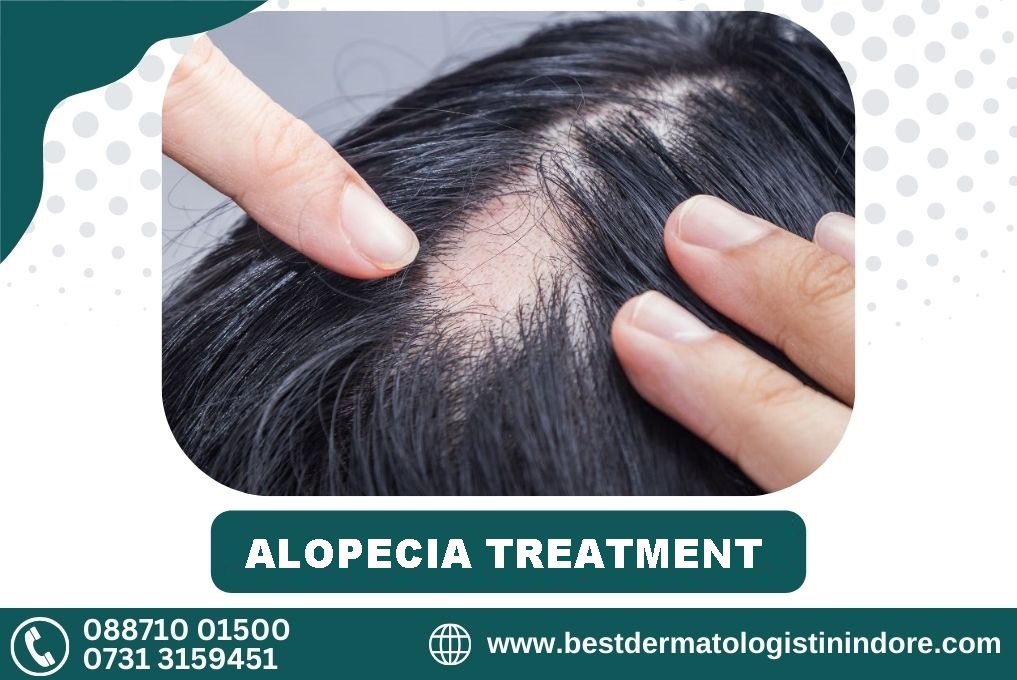 Best Hair Specialist for Alopecia Treatment in Indore