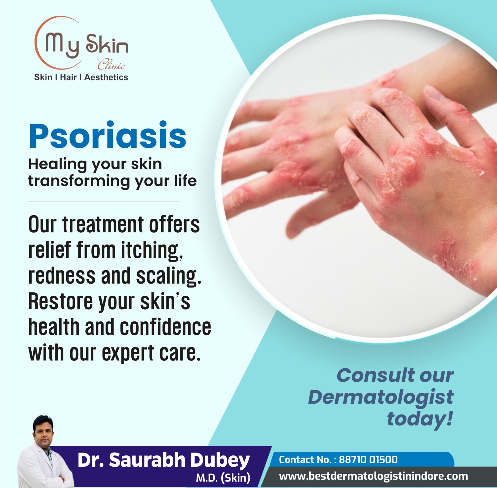 Best Skin Doctor for Psoraris Treatment in Indore