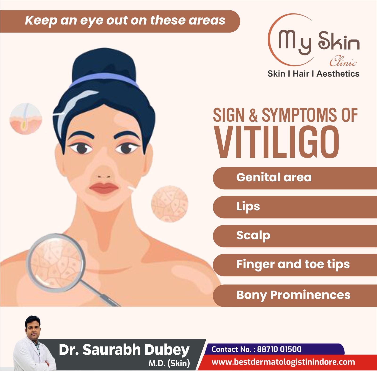 Best Skin Clinic For Vitiligo Treatment in Indore